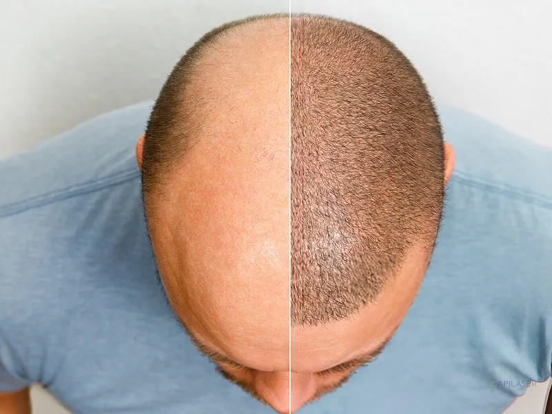 Greffe de cheveux à Sfax